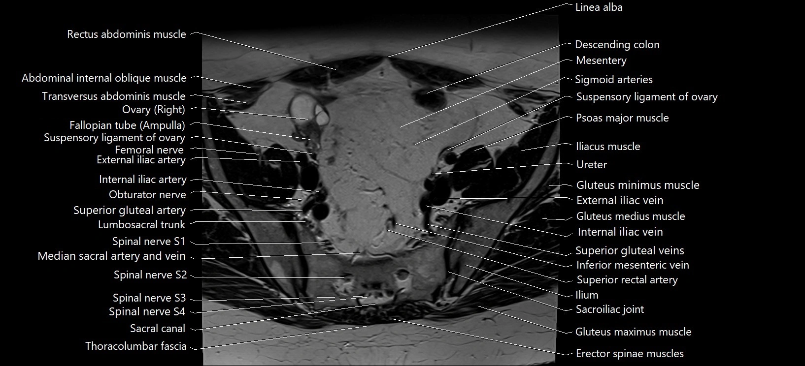 Axial cross sectional anatomy of female pelvis (MRI 3T) image 5.webp